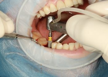 The key benefits of dental implants