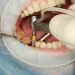 The key benefits of dental implants