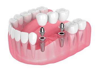 Implant Treatment in Turkey – How Does the Process Work?