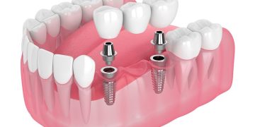 Implant Treatment in Turkey – How Does the Process Work?