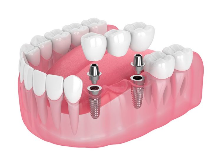 Implant Treatment in Turkey – How Does the Process Work?