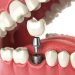 Why Dental Implants In Birmingham Are So Popular