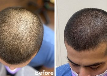 How Scalp Micropigmentation Manchester Works