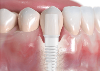 Why More People are Choosing Ceramic Dental Implants