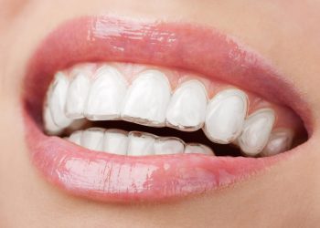 A Discreet Path to a Brighter You: Why Essex Residents are Choosing Invisalign for Smile Correction