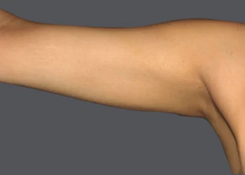 Reshaping Your Arms with Precision: A Comprehensive Guide to Arm Vaser Liposuction