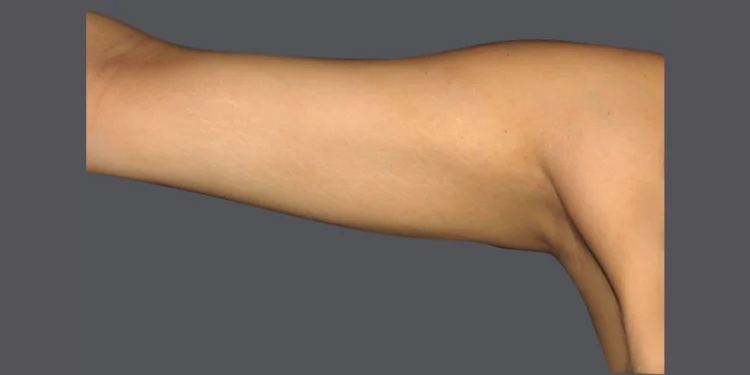 Reshaping Your Arms with Precision: A Comprehensive Guide to Arm Vaser Liposuction