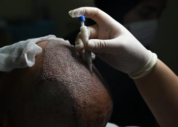 Exploring the Advantages of Choosing a DHI Hair Transplant