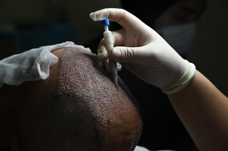 Exploring the Advantages of Choosing a DHI Hair Transplant