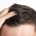 The Benefits of Using Hair Growth Serum Treatment for Thinning Hair