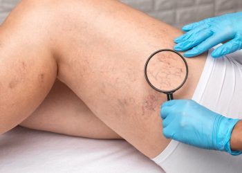 Say Goodbye to Spider Veins: Exploring Treatment Options