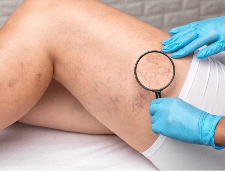 Say Goodbye to Spider Veins: Exploring Treatment Options