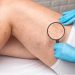 Say Goodbye to Spider Veins: Exploring Treatment Options