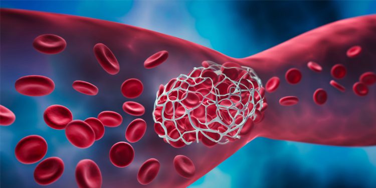 The Importance of Blood Clot Charities in Raising Awareness and Supporting Patients