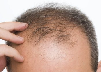 The Case for Seeking Treatment at a Hair Transplant Clinic London Specialists Recommend