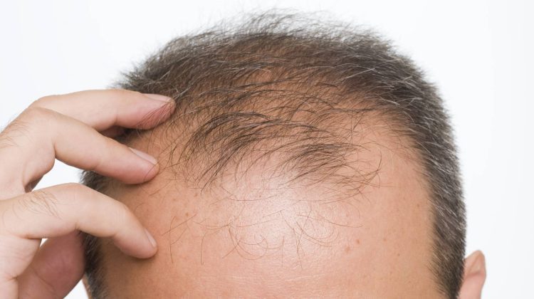 The Case for Seeking Treatment at a Hair Transplant Clinic London Specialists Recommend