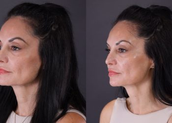 Why Credible Skin Tightening Clinics Always Display Xerf Treatment Before After Evidence