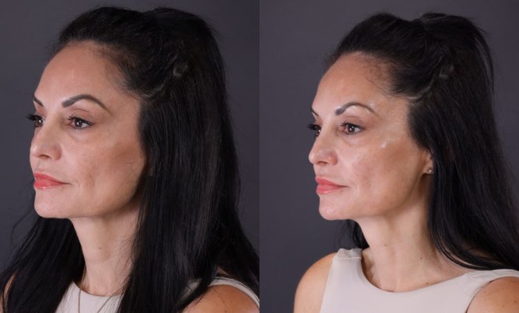 Why Credible Skin Tightening Clinics Always Display Xerf Treatment Before After Evidence