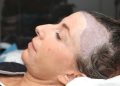 How to Choose the Best Hair Transplant London Surgeon for Female Hair Loss