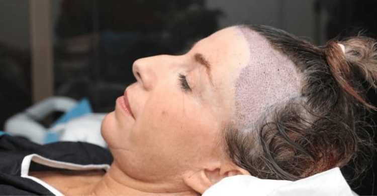 How to Choose the Best Hair Transplant London Surgeon for Female Hair Loss